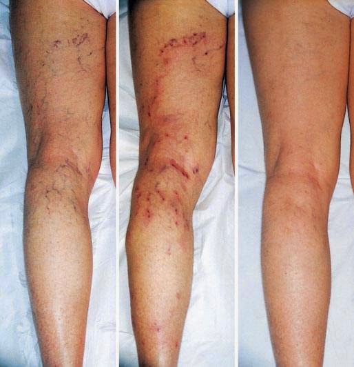 Atopitchesky la dermatite autour des yeux chez lenfant